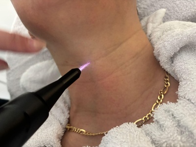 1 zone, 10 minuten: 1x Fusion Cold Plasma - Elify Pure Beauty