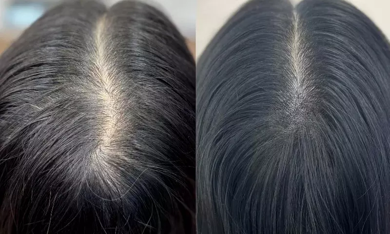 Scalp Micropigmentation Hair Loss, Balding, or Thinning Treatment