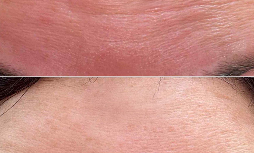 Image 2: Up to 37% Off on Injection-Other-Dysport, Xeomin at Luxe Aesthetics SA