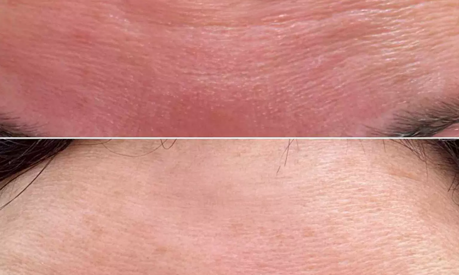 Up to 37% Off on Injection-Other-Dysport, Xeomin at Luxe Aesthetics SA - Second Medium