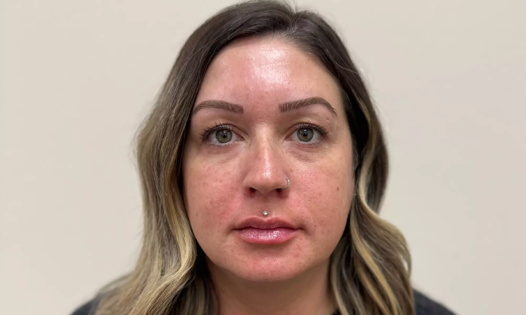 Botox Units (20–40) & Combo/Optional Lip Filler Syringe Injectables