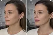 Achieve Flawless Skin with Perfect Aesthetics and Spa's 20 or 40 Unit of Botox Deals (Up to 56% Off) - Second Medium
