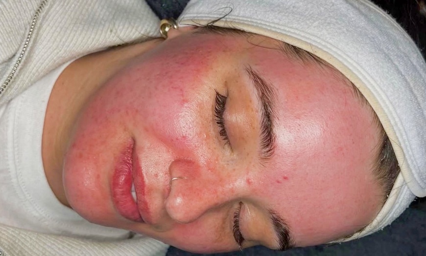 Image 3: One or Three Sessions of Microneedling with Skin Nourishing Serum