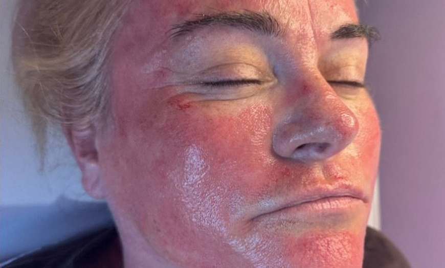 Image 3: One or Three Microneedling Sessions with Skin Booster