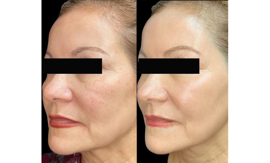 Image 2: One Fraxel Laser Skin Resurfacing Treatment for Neck or Full Face