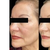 Image 2: One Fraxel Laser Skin Resurfacing Treatment for Neck or Full Face