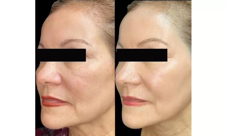 One Fraxel Laser Skin Resurfacing Treatment for Neck or Full Face