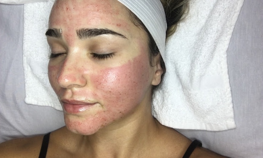 Image 2: Rejuvenate Your Skin with Microneedling and RF Treatments