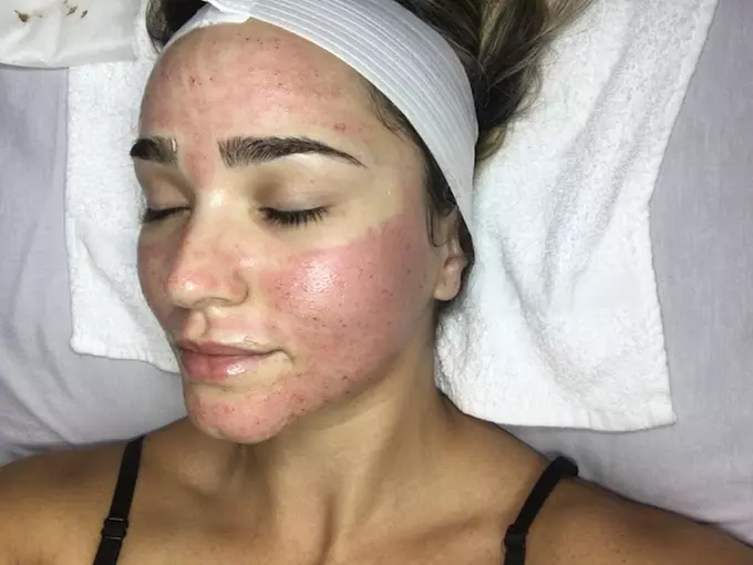 Unlock Radiant Skin at RC Holistic Hands Spa with Microneedling Options Up to 63% Off - Second Medium