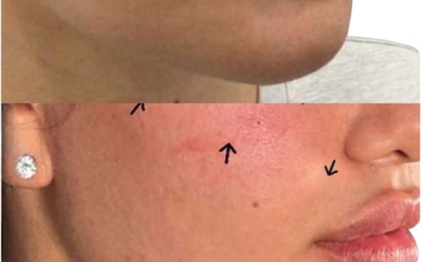 Image 3: Get a Dermal Filler Today: 1ml or 2ml Lips