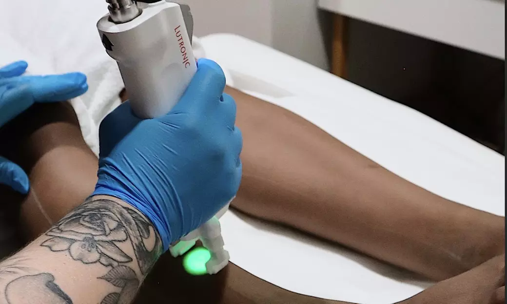 Laser Hair Removal Session - Brazilian, Underarms, Full Leg, or Back
