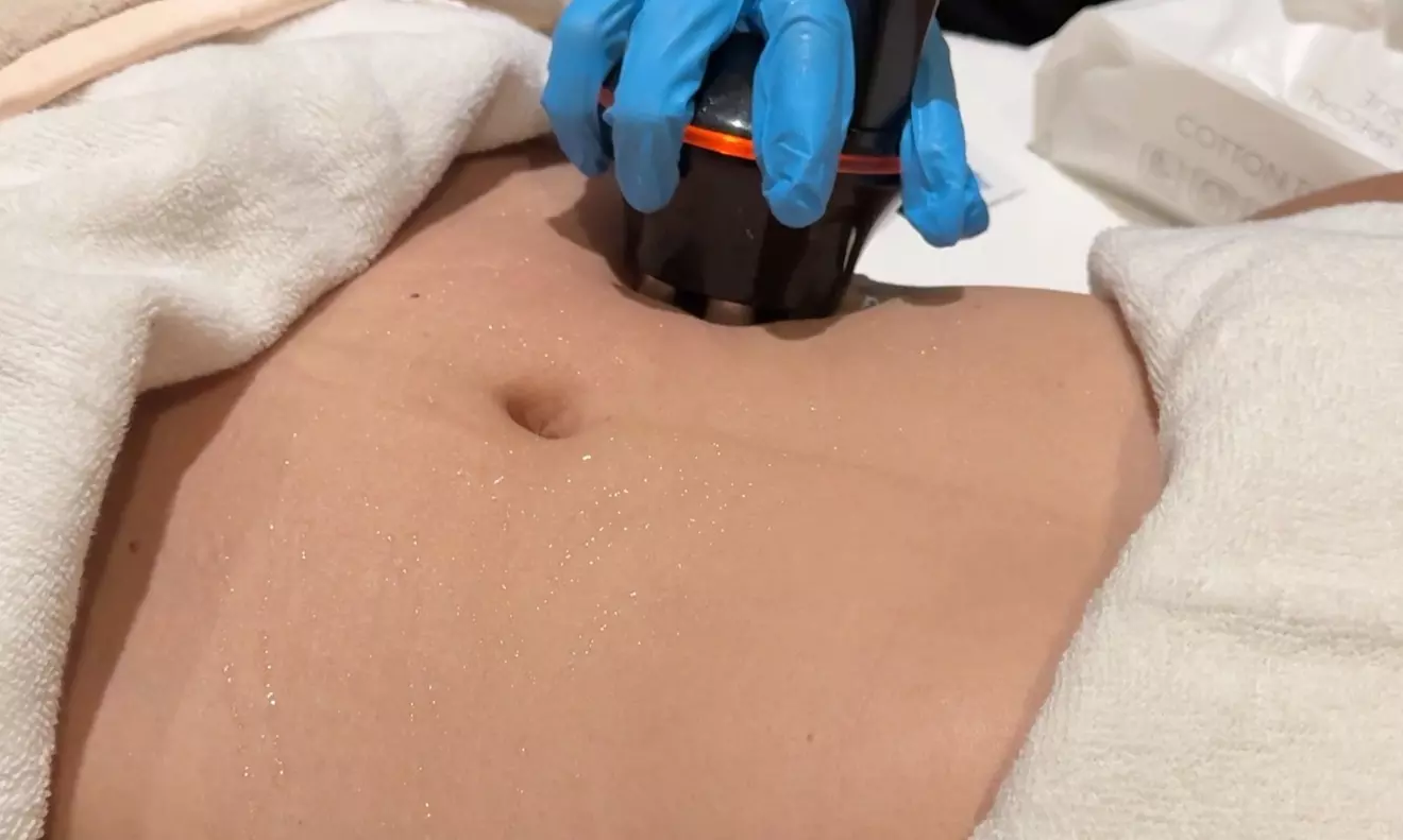 Sense Skincare And Wellness: TriLift and Fotona Skin Tightening