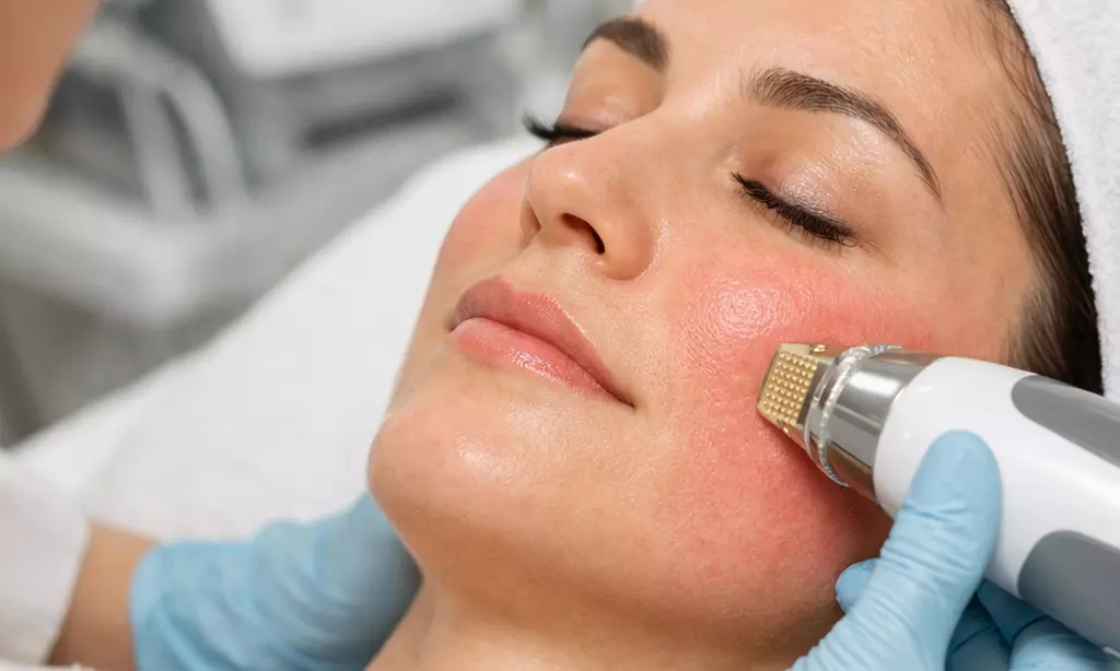 Microneedling Gesicht, Hals oder Dekolleté oder komplett für 1 Person