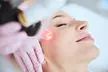 CO2 Skin Resurfacing Treatment: Full-Face/Neck and Décolletage/Tummy at SlimmThicc Aesthetics Spa (upto 70% Off) - Second Medium