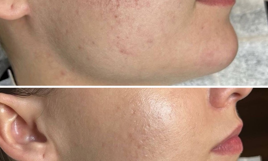 Image 2: BB Glow-Gesichtsbehandlung oder Aquapeel Hydra Pur für 1 Person