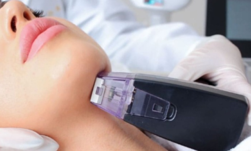 Image 2: Up to 90% Off Morpheus8 RF Microneedling 
