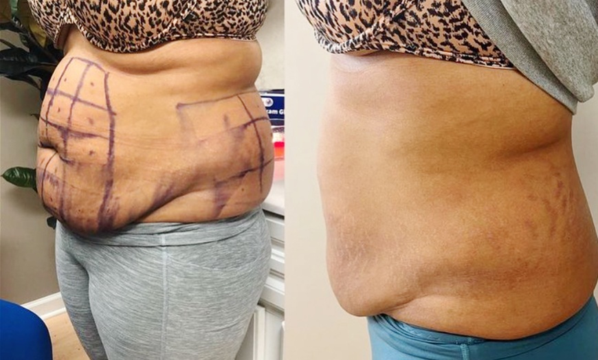 Image 5: 60 Minute Lymphatic Drainage Massage: 1 or 3 Sessions