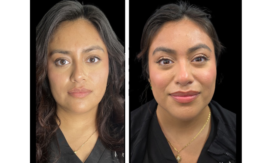 Image 4: Refresh Your Look with 20 or 40 Units of Xeomin