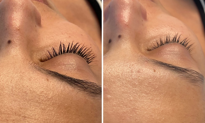 Image 8: Microneedling-Behandlung oder Enzym-Lifting-Paket für 1 Person