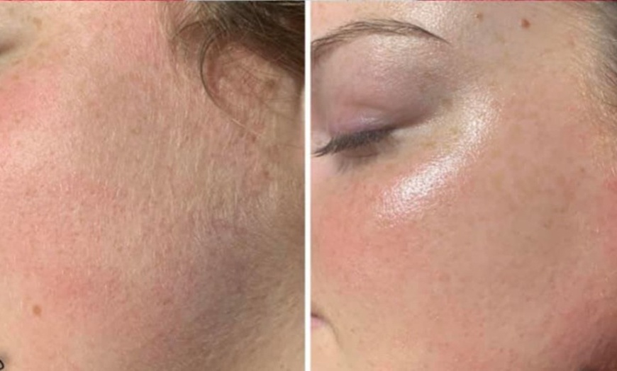 Image 5: Up to 57% Off on Facial - Fruit Acid Peel at SKIN IQ Aesthetics & Wellness