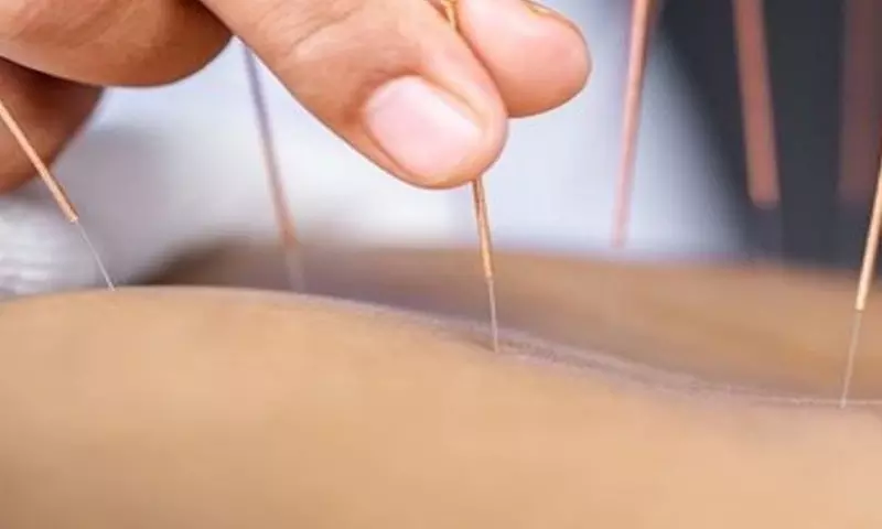 Acupuncture Cupping Scraping Hot-towel compression, Massage or More