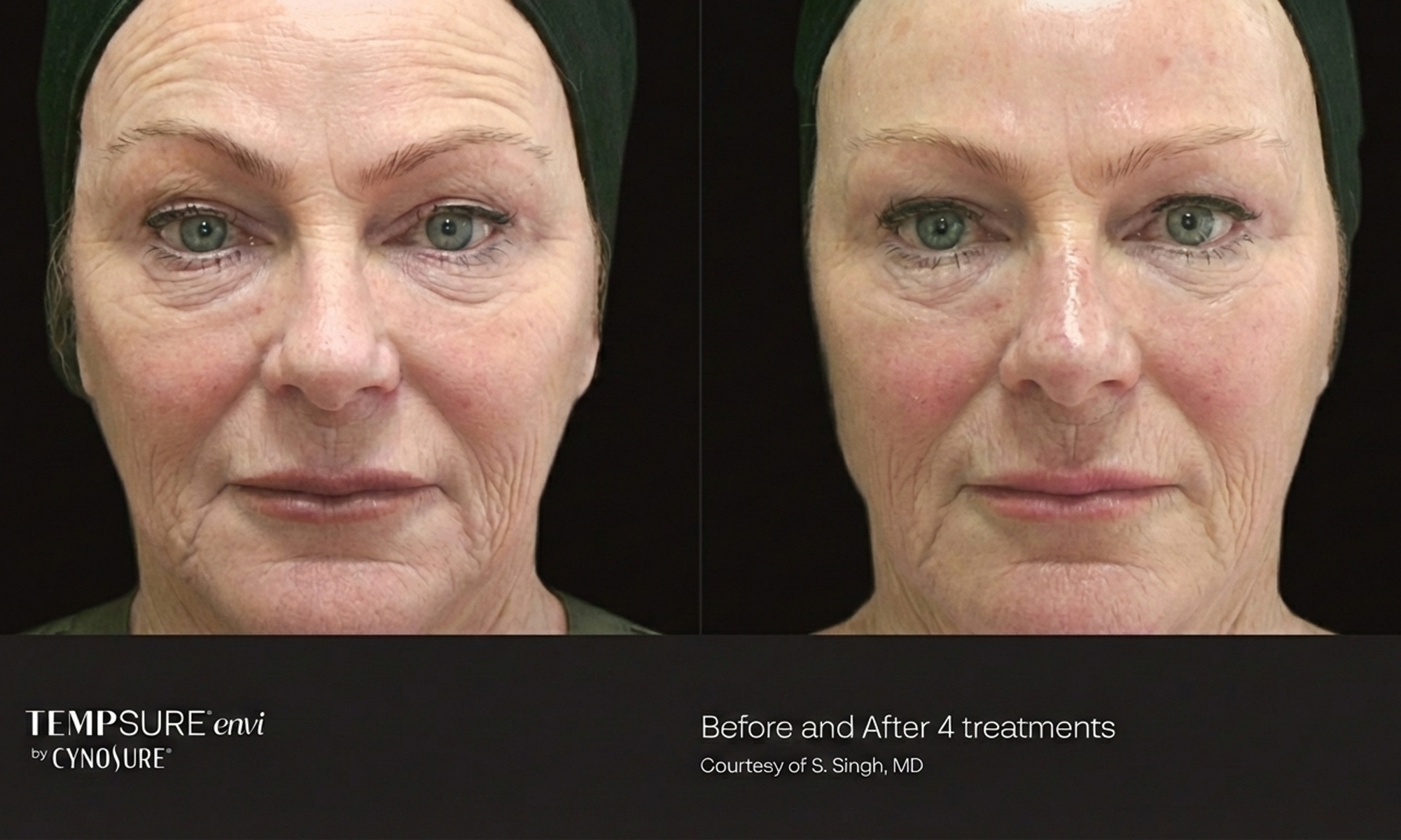 TempSure RF Face & Neck Skin Tightening