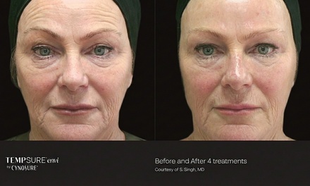 One TempSure Smile Lines or Eye Treatment - Dr. Rick A. Carpenter