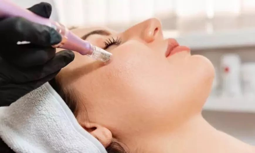Image 3: Revitalize with One or Two Sessions of Microneedling and LED Therapy!