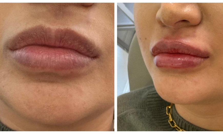 Image 5: 1ml or 2ml Dermal Filler Treatment on Lips with Consultation