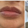 Image 5: 1ml or 2ml Dermal Filler Treatment on Lips with Consultation