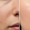 Image 1: Smooth, Clear, Radiant—PCA Chemical Peel at Soft Touch Electrolysis