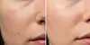 Smooth, Clear, Radiant—PCA Chemical Peel with Advanced Treatment Boosters at Soft Touch Electrolysis