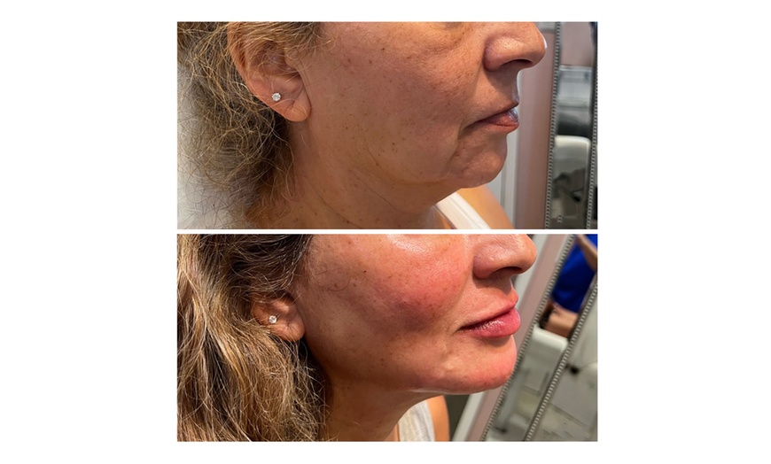 Image 6: Get 20, or 40 Units of Injection - Botox (Dysport/Xeomin Brand)