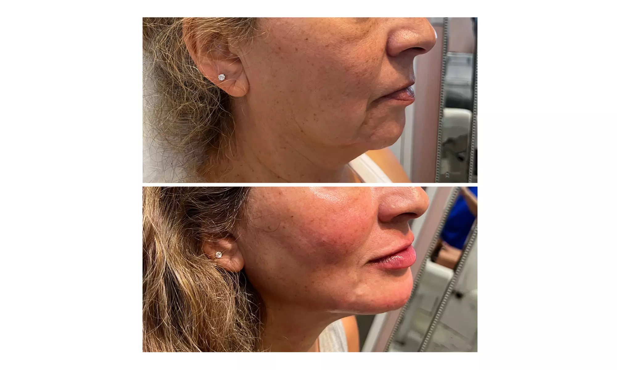Get 20, or 40 Units of Injection - Botox (Dysport/Xeomin Brand)