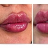 Image 1: Enhance Your Look with 0.5ml or 1ml of Dermal Fillers Options 