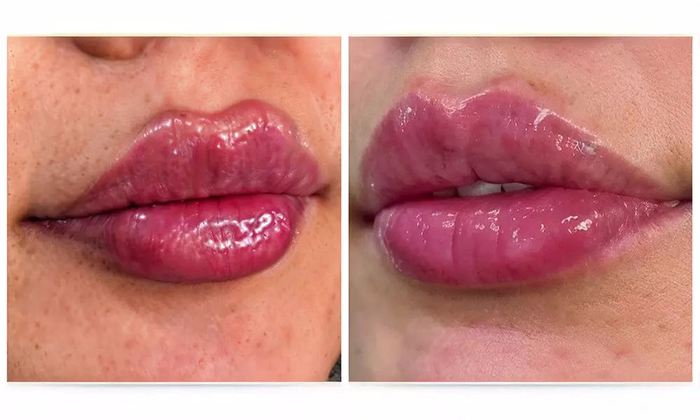 Enhance Your Look with 0.5ml or 1ml of Dermal Fillers Options