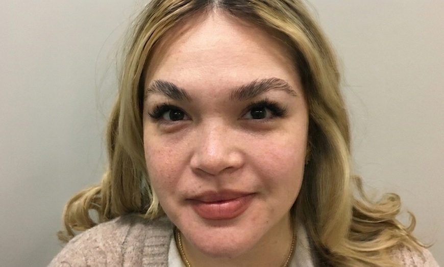 Image 4: 1, 3, or 5 Fractional Laser Skin Resurfacing Sessions for Full Face