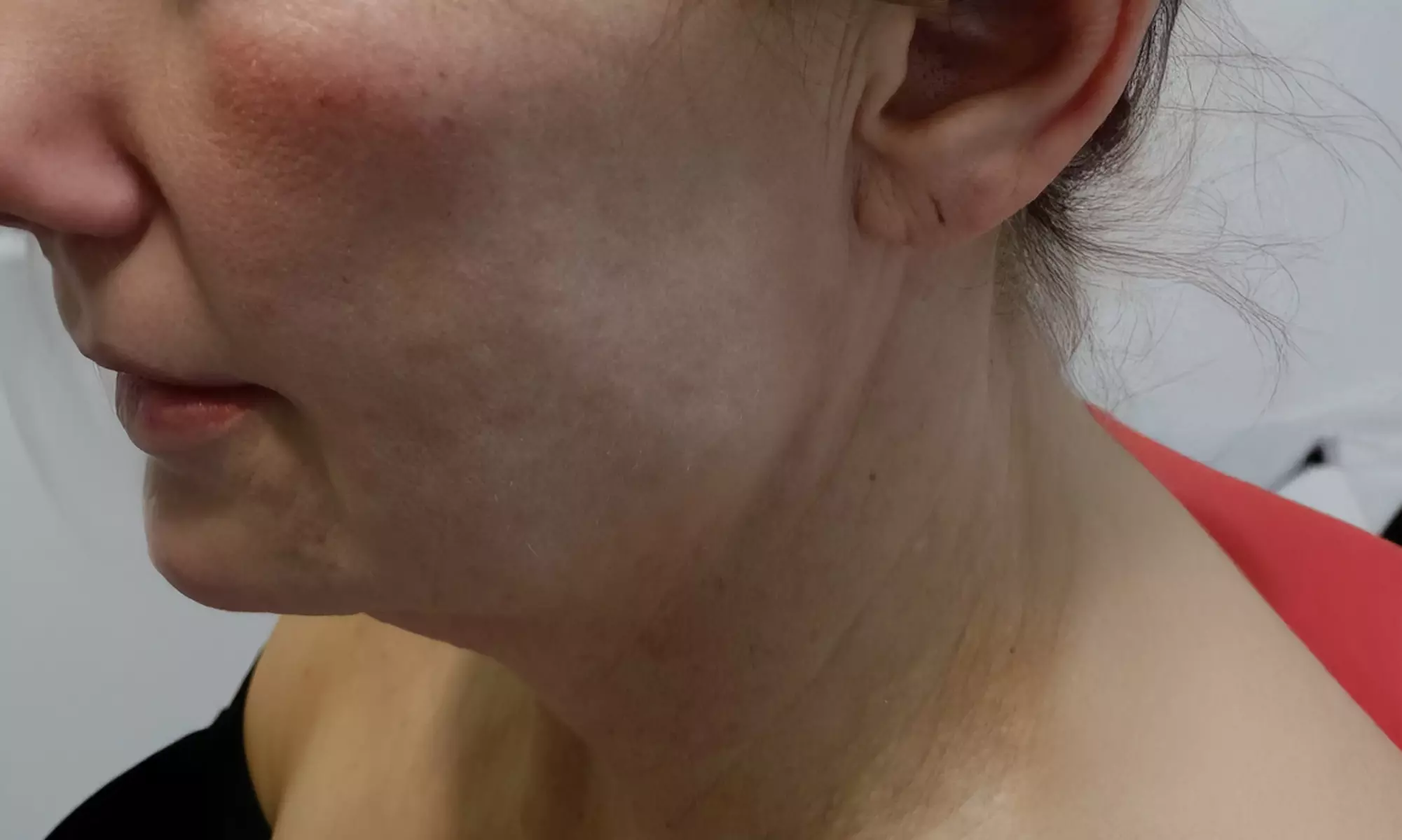 Tratamiento HIFU V10 MAX INDOLORO en rostro para 1 persona