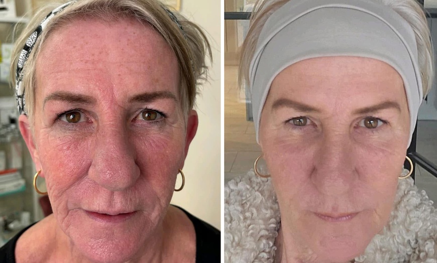 Image 2: Enhance Your Beauty with 2, 4 or 6 Sessions Microcurrent Facelift