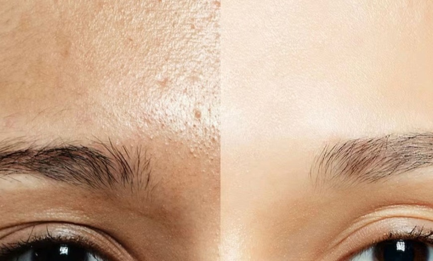 Image 6: Aqua Facial opt. mit Microneedling oder BB-Glow für 1 Person