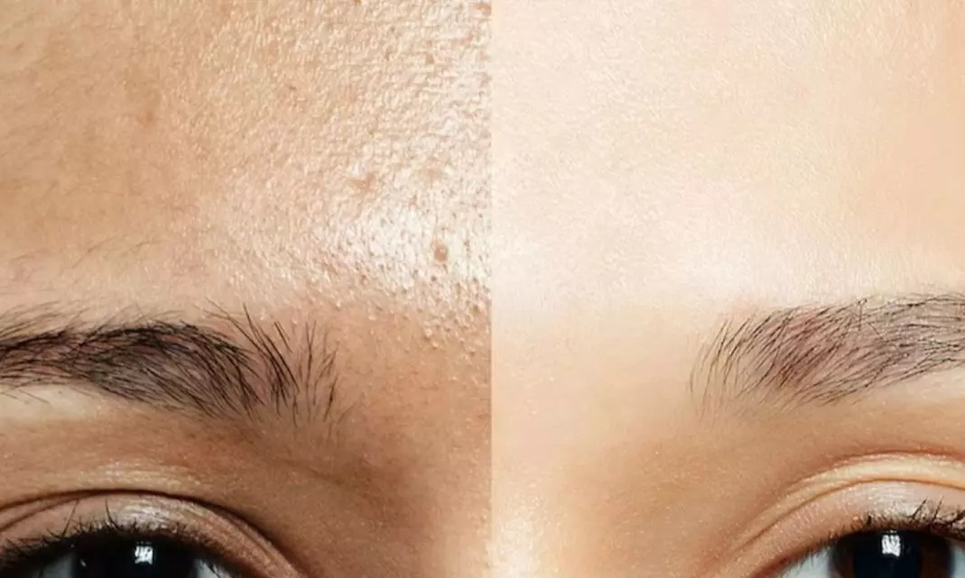 Aqua Facial opt. mit Microneedling oder BB-Glow für 1 Person