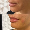 Image 3: Up to 37% Off on Injection - Dermal Filler at Holistic Health and Medical