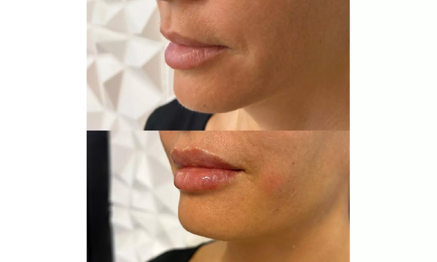 Enhance Your Lips with Half or Full Syringe Fillers
