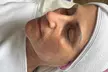Aqua Facial und/oder Microneedling für 1 Person (bis zu 39% sparen) - Second Medium