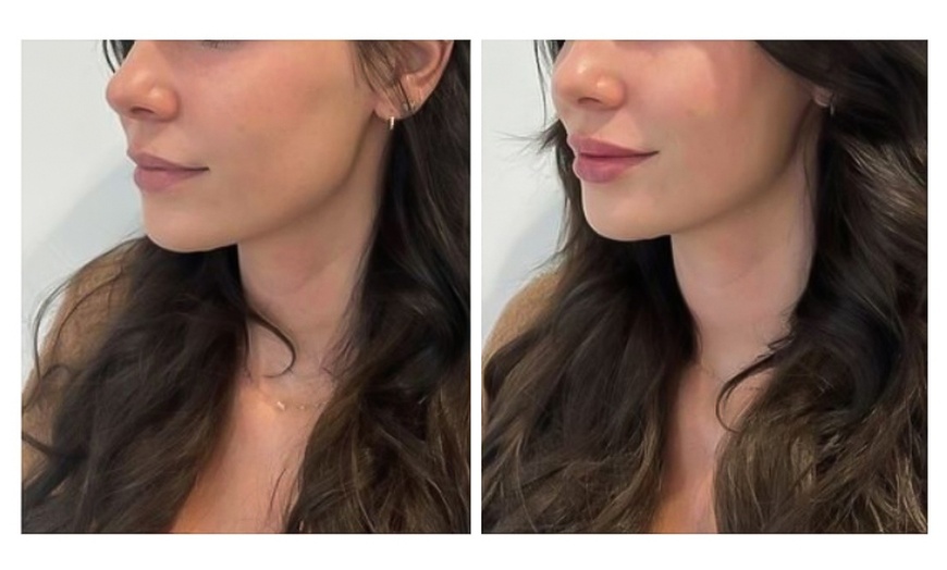 Image 2: Up to 45% Off on Injection - Restylane at Recharge Lab