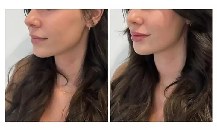 Up to 45% Off on Injection - Restylane at Recharge Lab - Second Medium