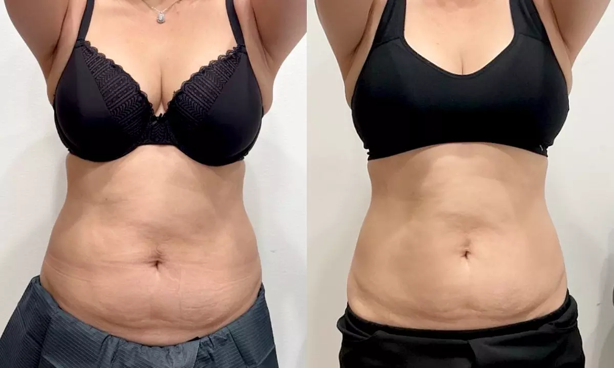 Reshape w/t 6 or 12 EvolveX Body Contour Sessions at Core - Up to 50% Off - Second Medium