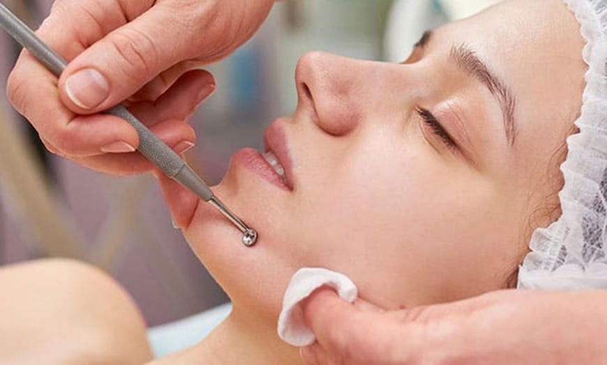 Image 2: Limpieza facial con opción a microdermoabrasión, radiofrecuencia y más