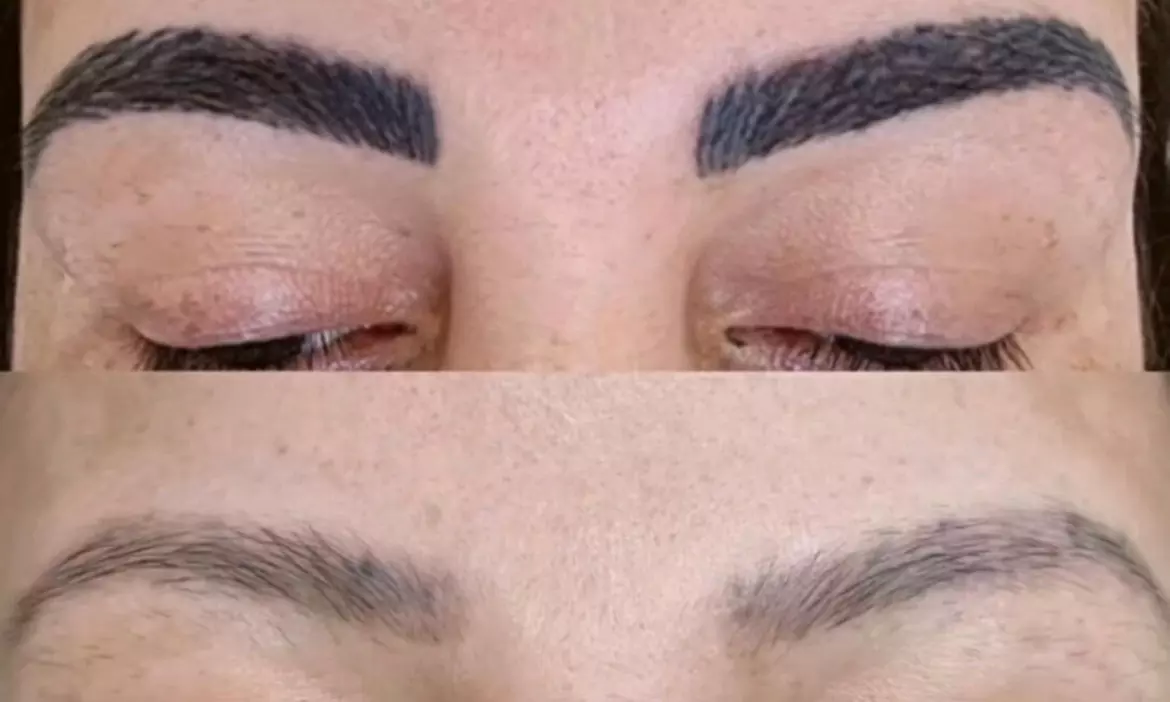 Get Three Microblading Permanent Makeup Removal, One or Three Laser Tattoo Removal Sessions & More(Up to 75%Off) - Second Medium
