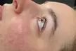 Transform Your Look with One Eyelash Tinting and Lift Treatment at PureSkin Esthetics ( Up to 55% Off ) - Second Medium